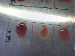 RhO+ – Fundación Hipercolesterolemia Familiar